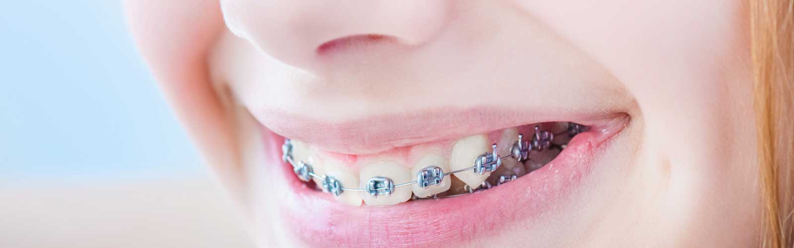 Teeth With Braces Image