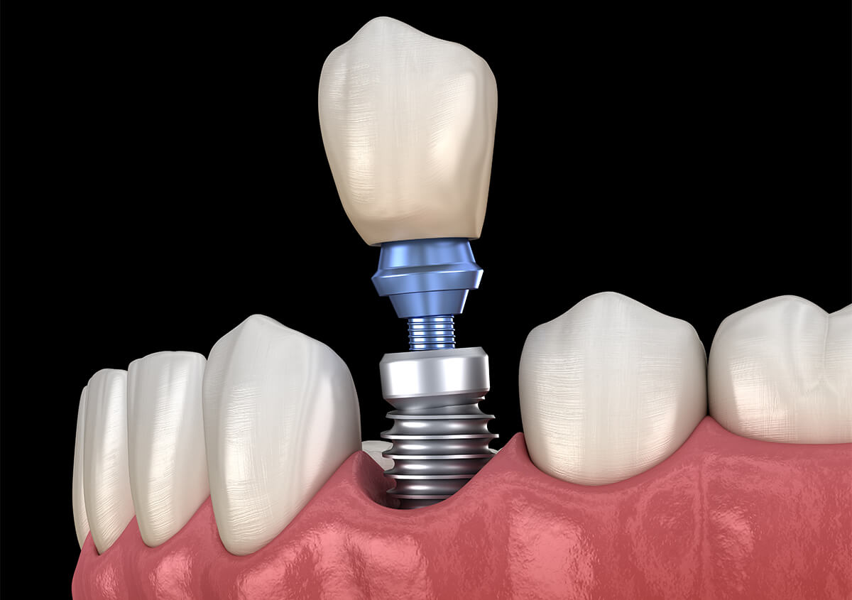 Teeth Implants Dentist in Bolton ON Area