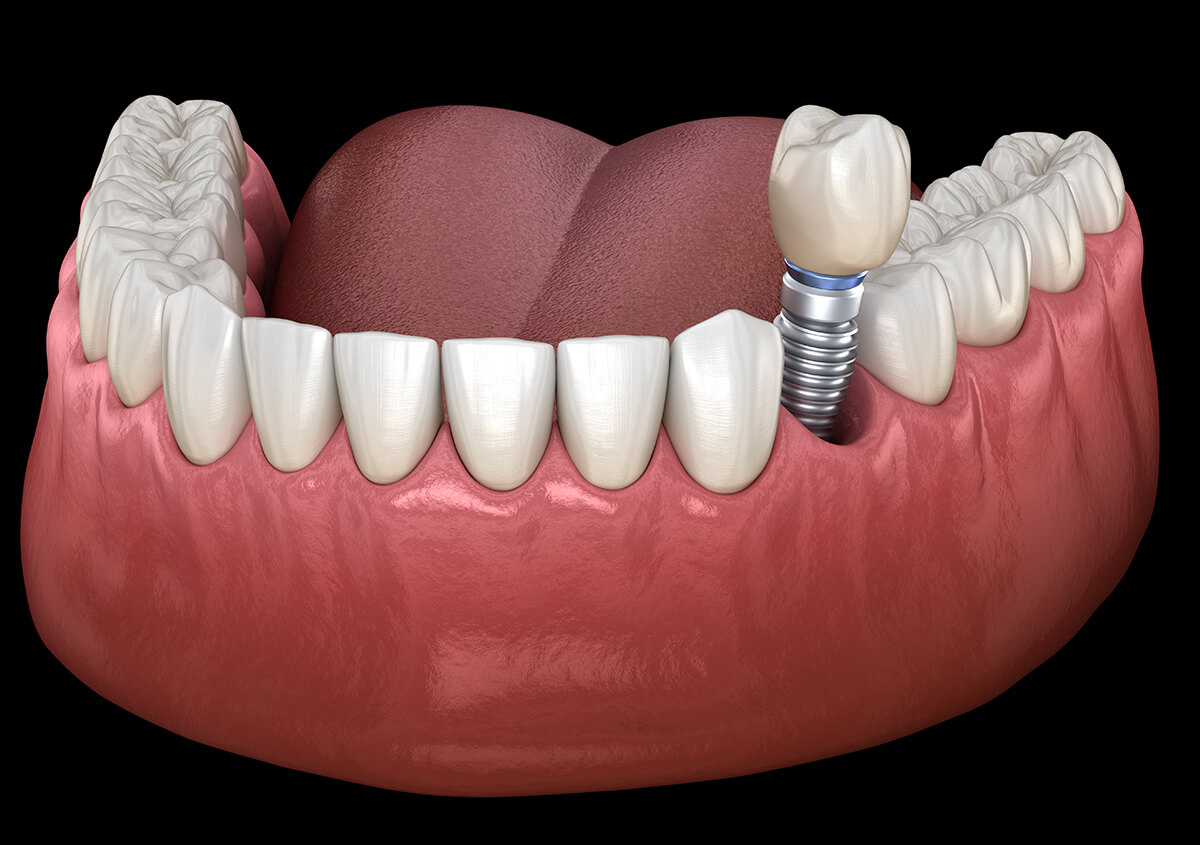 Dentist for Dental Implants in Bolton ON Area