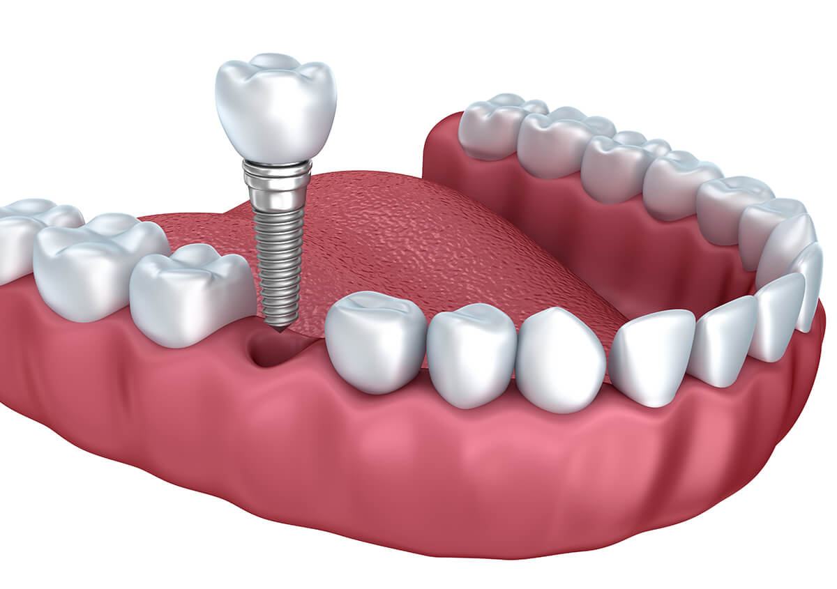 Missing Teeth Dental Implants in Bolton ON Area