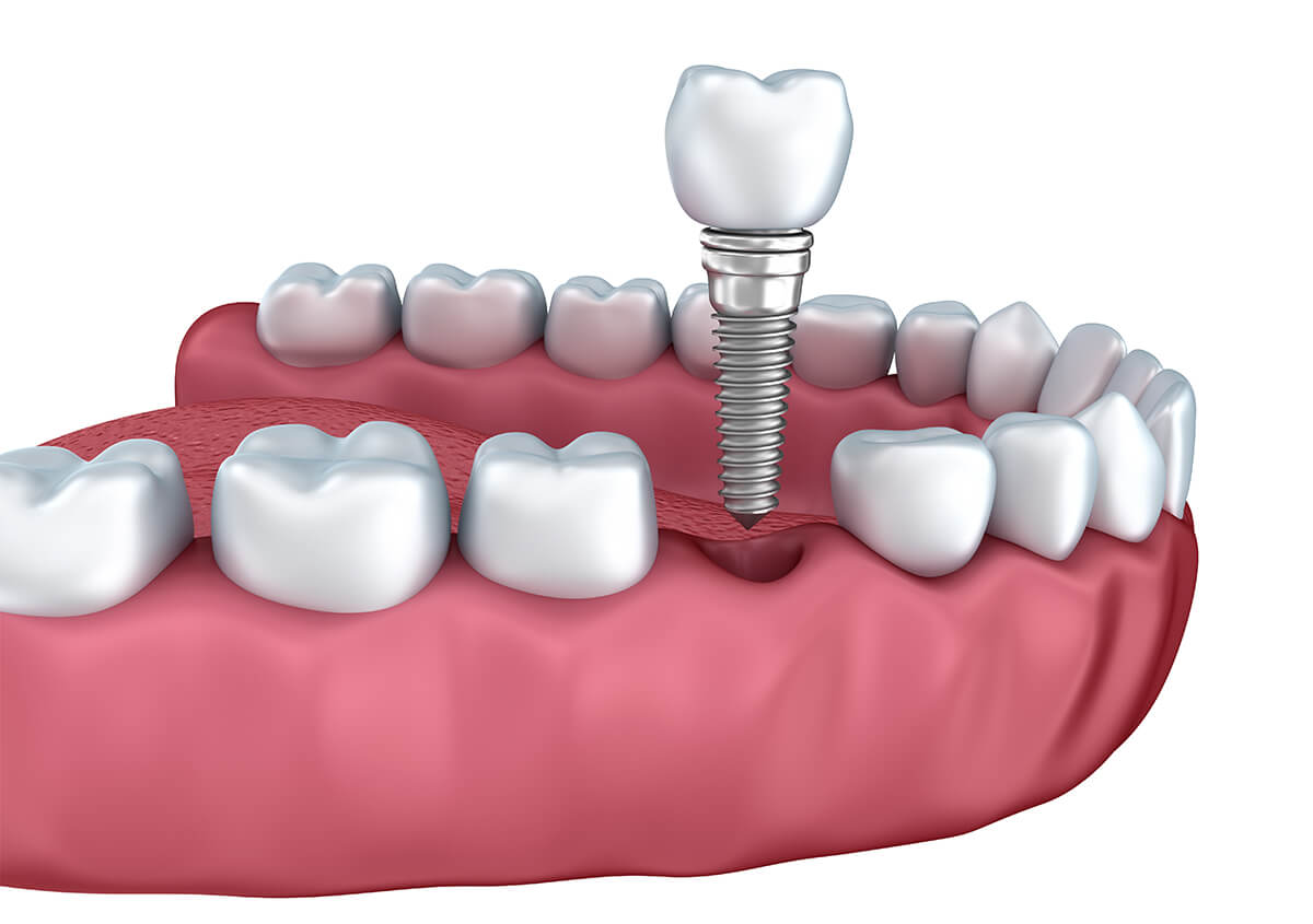Types of Dental Implants in Bolton ON Area